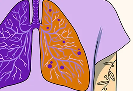 Illustration of a person wearing a purple shirt with an artistic depiction of lungs in purple and orange.