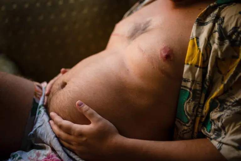Pregnant transgender man gently holding his belly, showing top surgery scars and embracing trans parenthood.